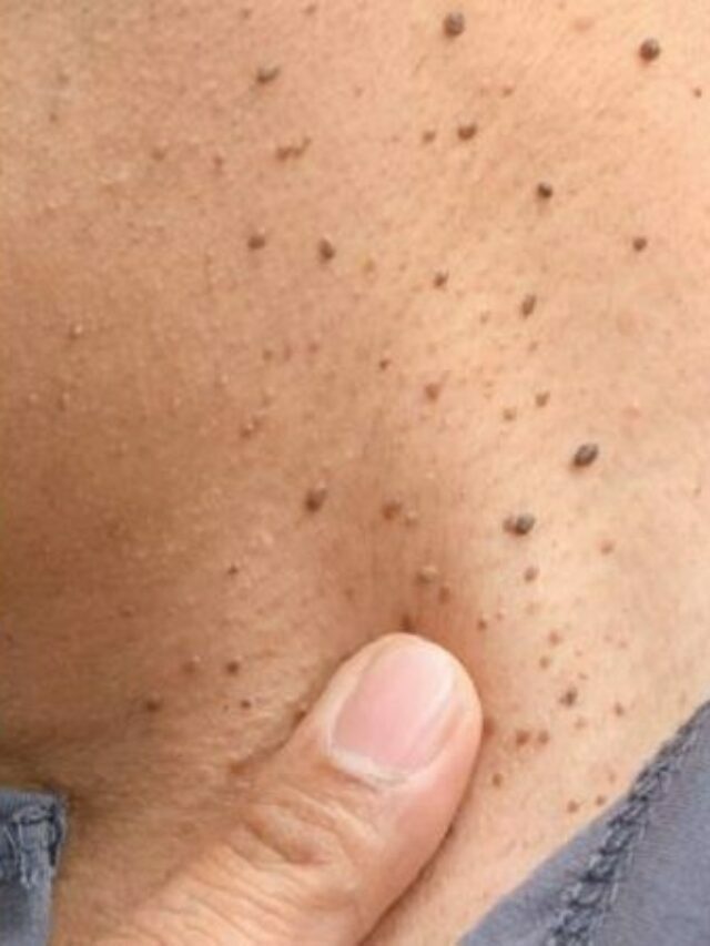 Você tem sinais como estes na pele? Saiba dos riscos